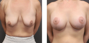 ba007 breast augmentation front view
