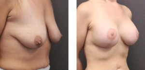 ba007 breast augmentation oblique view