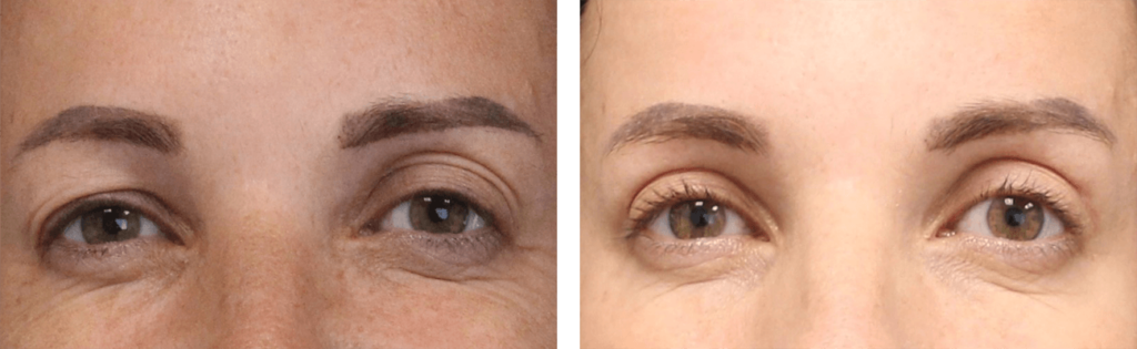 Patient is in her mid 40's had an upper eye lift. 3 months post op.