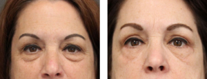 Patient is in her mid 60's who had an upper and lower blepharoplasty.3 months post op.