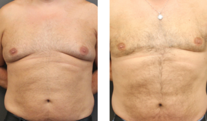 Patient in his early 50's that had liposuction of his chest and lateral chest pics are consult and 3 months post op