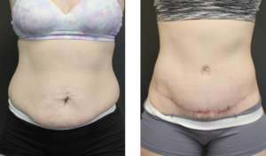 Patient is in her early 30's with a tummy tuck she is 6 months post op.