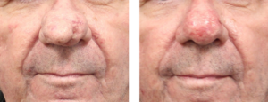 Patient in his early 70's who had excision and cautery of Rhinophyma. He is about 3 weeks post op.