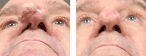 Patient in his early 70's who had excision and cautery of Rhinophyma. He is about 3 weeks post op. Looking up.