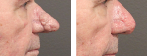 Patient in his early 70's who had excision and cautery of Rhinophyma. He is about 3 weeks post op. Side View.